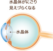 水晶体がにごり見えづらくなる
